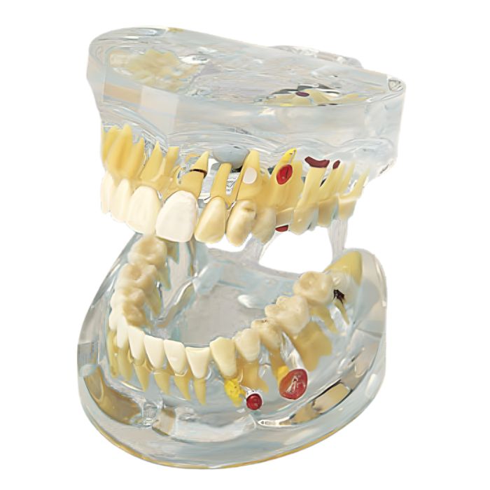 Transparent Dental Pathology Model