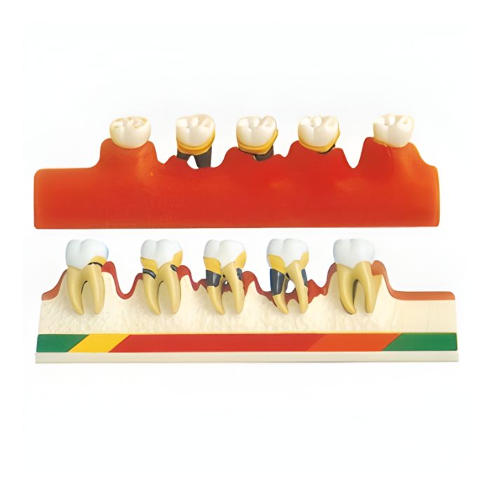 Periodontal Disease Model